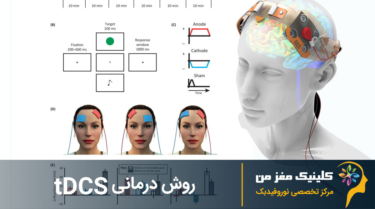 روش درمانی tDCS برای افسردگی