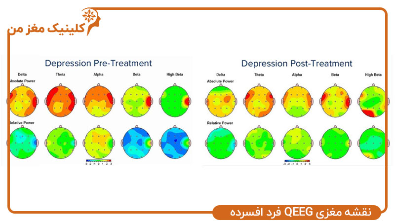 نقشه مغزی QEEG فرد افسرده