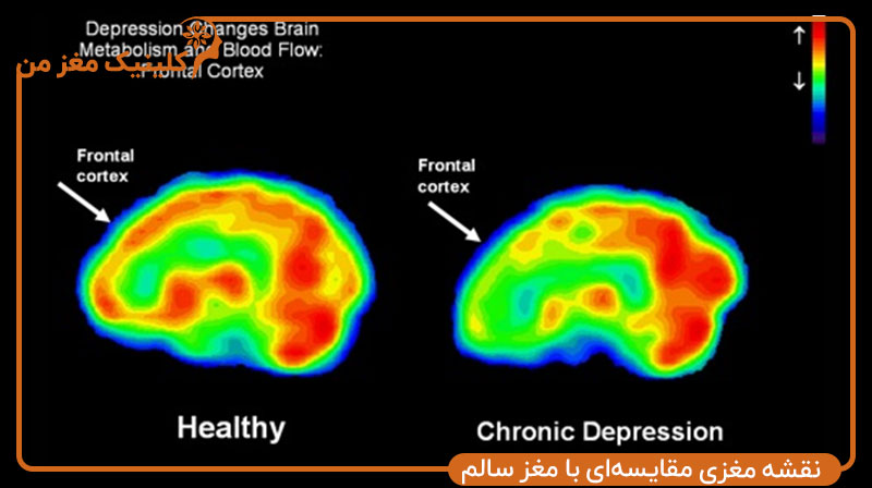 نقشه مغزی مقایسه‌ای با مغز سالم