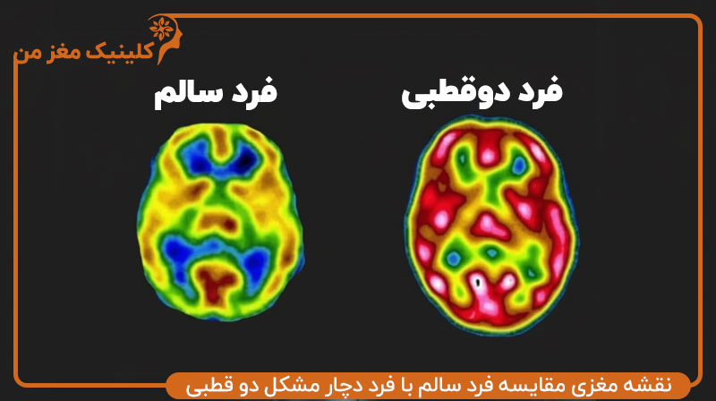 تفاوت بین افراد دوقطبی و افراد سالم در نقشه مغزی