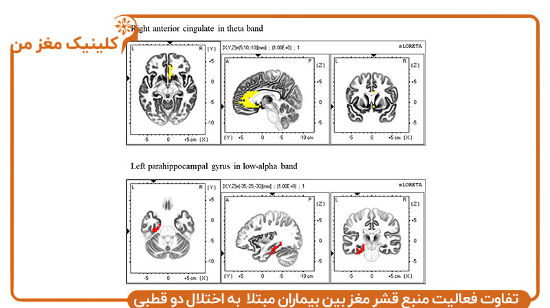 تفاوت فعالیت منبع قشر مغز بین بیماران مبتلا به اختلالات مغزی