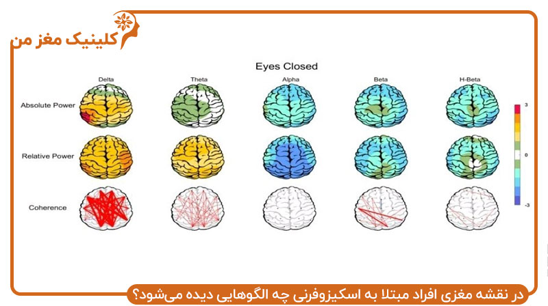 در نقشه مغزی افراد مبتلا به اسکیزوفرنی چه الگوهایی دیده می‌شود؟