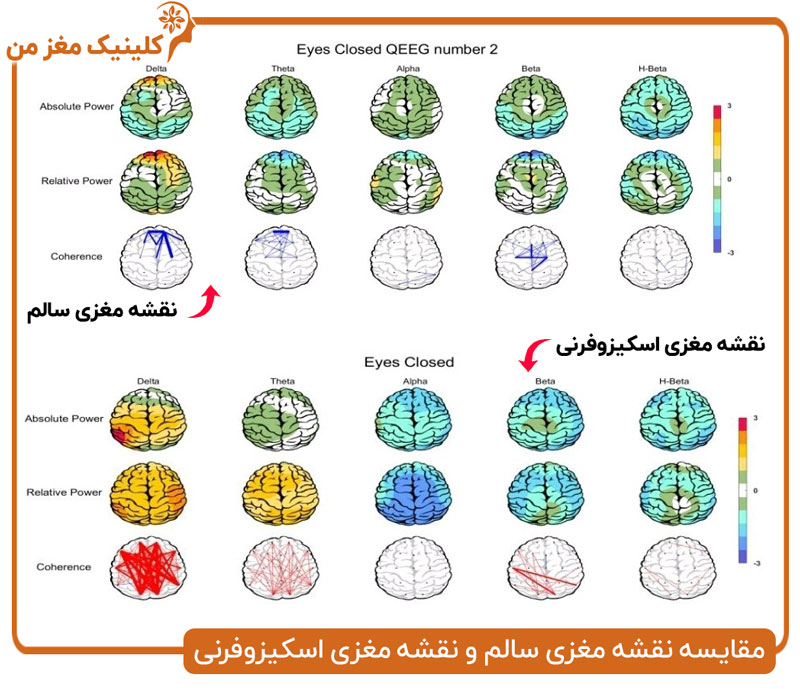 تفاوت نقشه مغزی فرد مبتلا به اسکیزوفرنی با مغز سالم